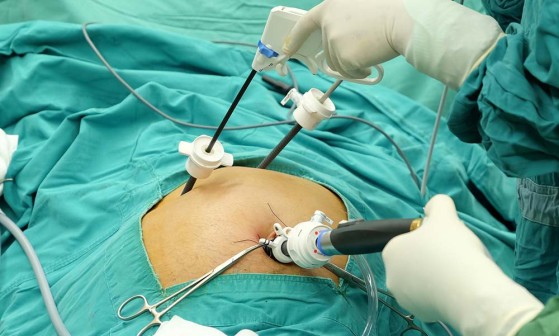 Intervenţie laparoscopică unui pacient cu dublă hernie