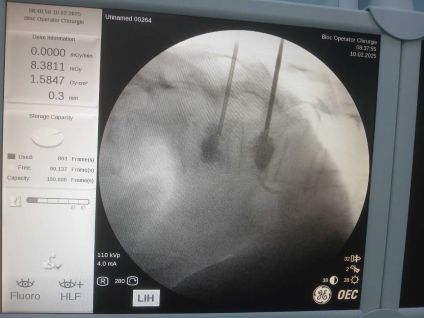 Vertebroplastie percutanăIntervenție neurochirurgicală în premieră la SJU Buzău
