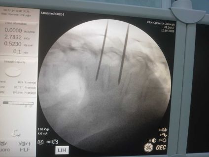 Vertebroplastie percutanăIntervenție neurochirurgicală în premieră la SJU Buzău